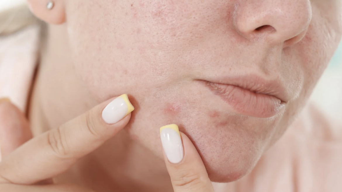 Acne Facial Medical Spa Appointment Near Sterling, Virginia